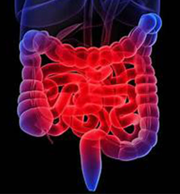 Inflammatory bowel disease (IBD)