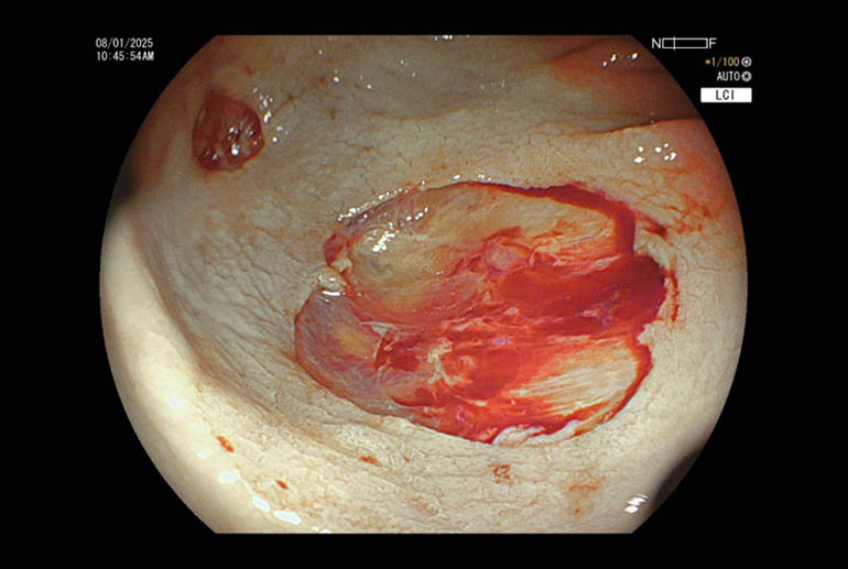Mucosal defects after removal of polyps (Clean margins/complete resection)Slight oozing of blood.