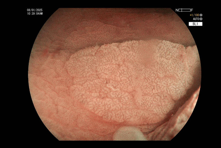 Polyp seen underwater (Hydroimmersion).