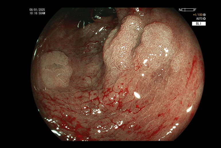 Polyps seen using image enhancement (Blue Light Imaging)Polyps seen using image enhancement (Blue Light Imaging)
