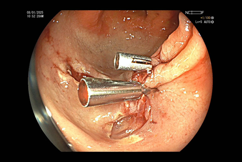 Haemoclipping (in process) for haemostasis