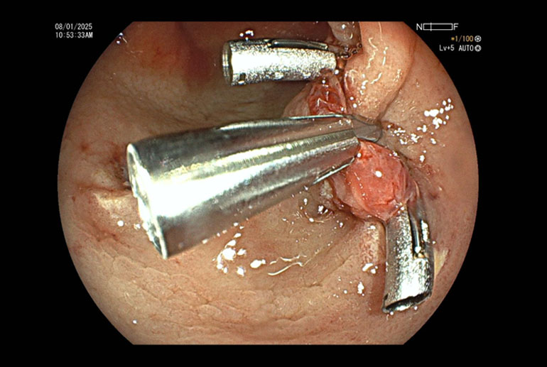 Haemoclipping (complete) for haemostasis