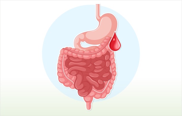 Stopping the Bleed: How GI Bleeding is Treated and Controlled
