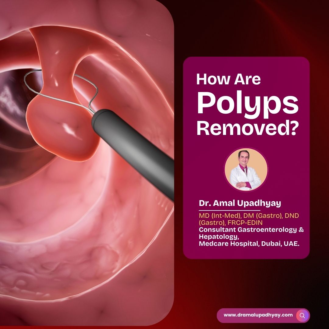 How Are Polyps Removed?
